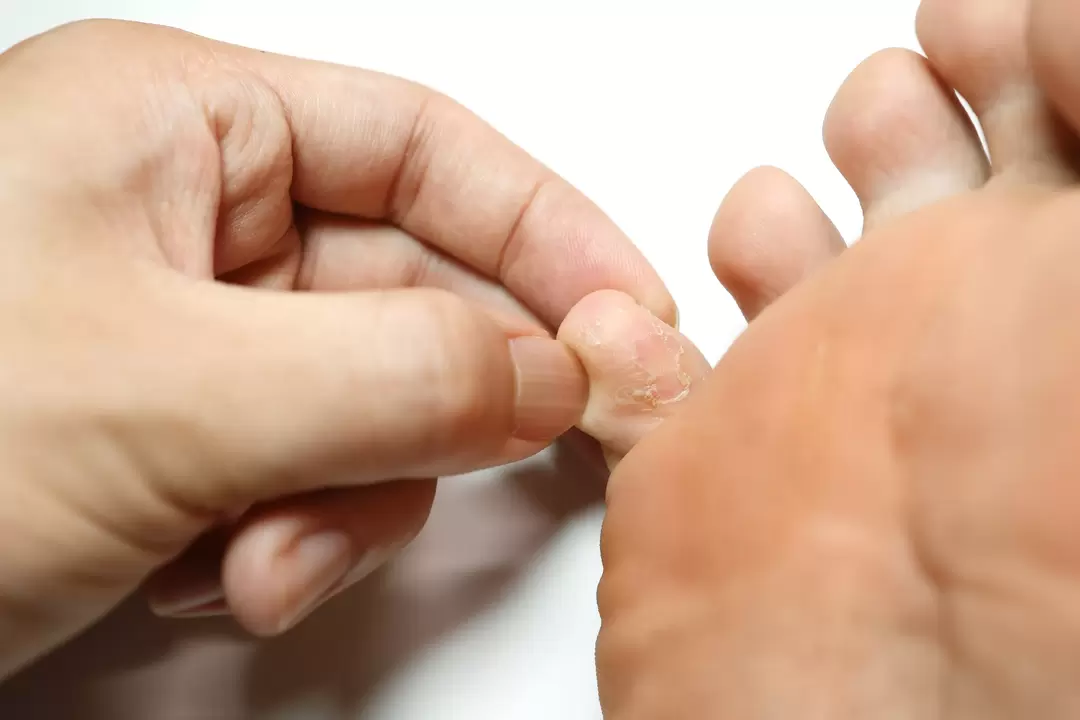 Hongo en los dedos y su tratamiento con crema Demyxil con crema