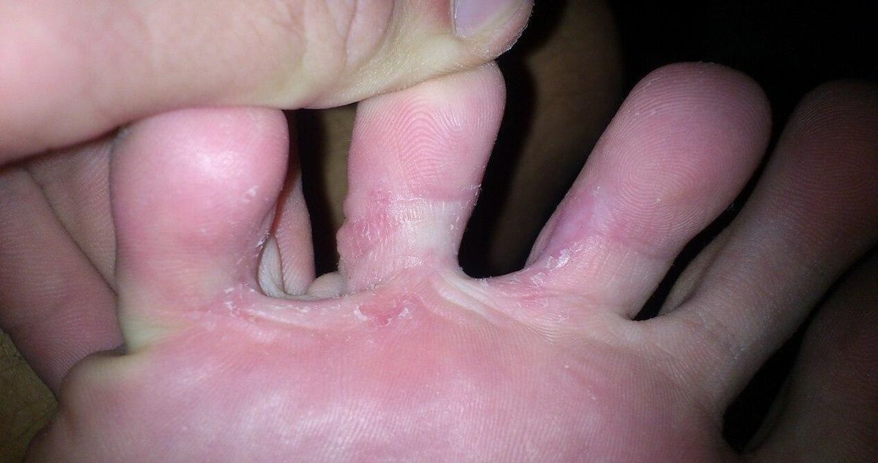 Hongo entre los dedos de los pies al tratamiento de la crema Demyxil