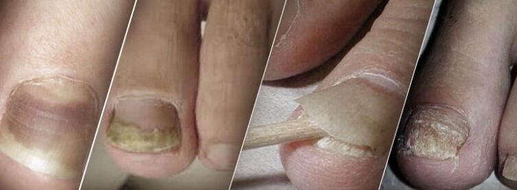 Onicomicosis