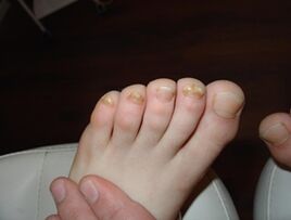 Onicomicosis