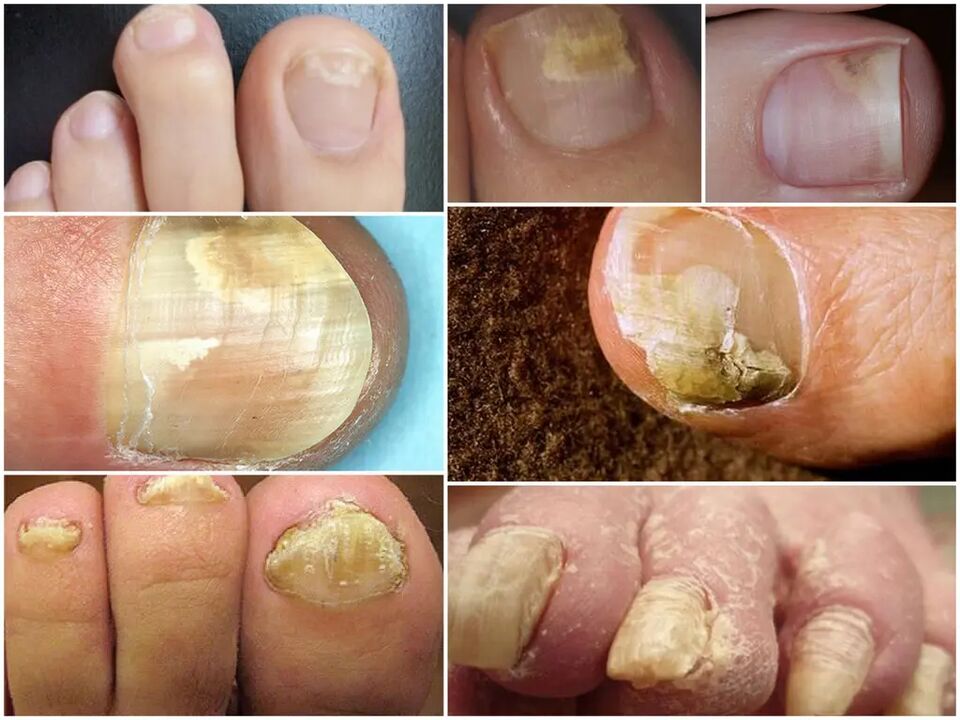 Etapas de desarrollo de hongos en las uñas de los pies.