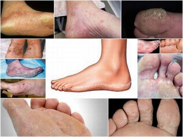 Forma escamosa-hiperqueratósica de micosis de los pies.