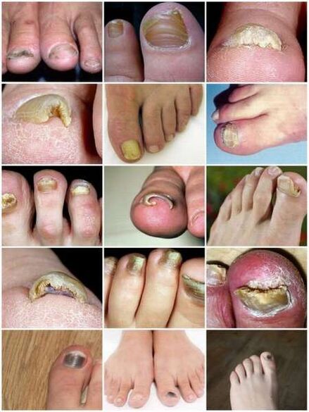 Infección por hongos de la placa de la uña del pie.