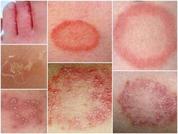 Tricofitosis de la piel de las piernas.