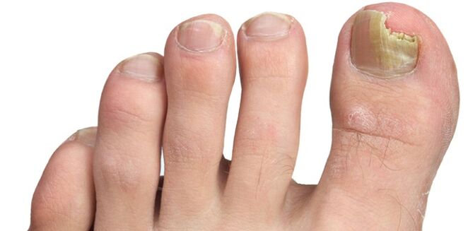 infección por hongos de la placa ungueal